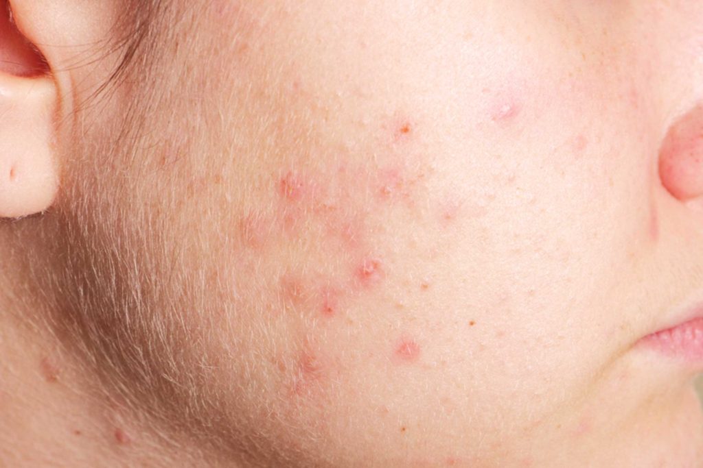 Le chardon Marie pourrait aider à traiter l'acné