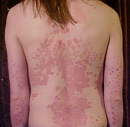 psoriasis et peau