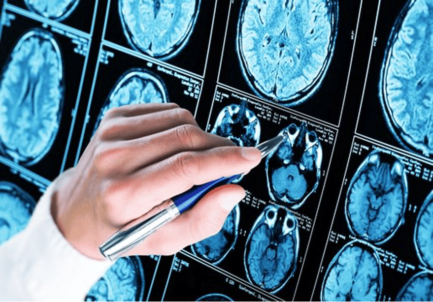 Alzheimer et système cérébral