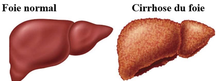 10 signes qui montrent que votre foie est malade