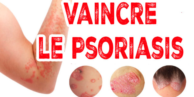 Psoriasis