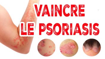 Psoriasis
