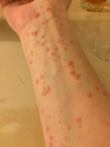 psoriasis et gouttes