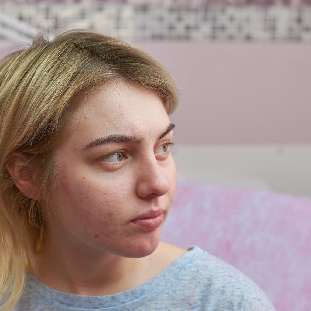 jeune femme avec de l'acné