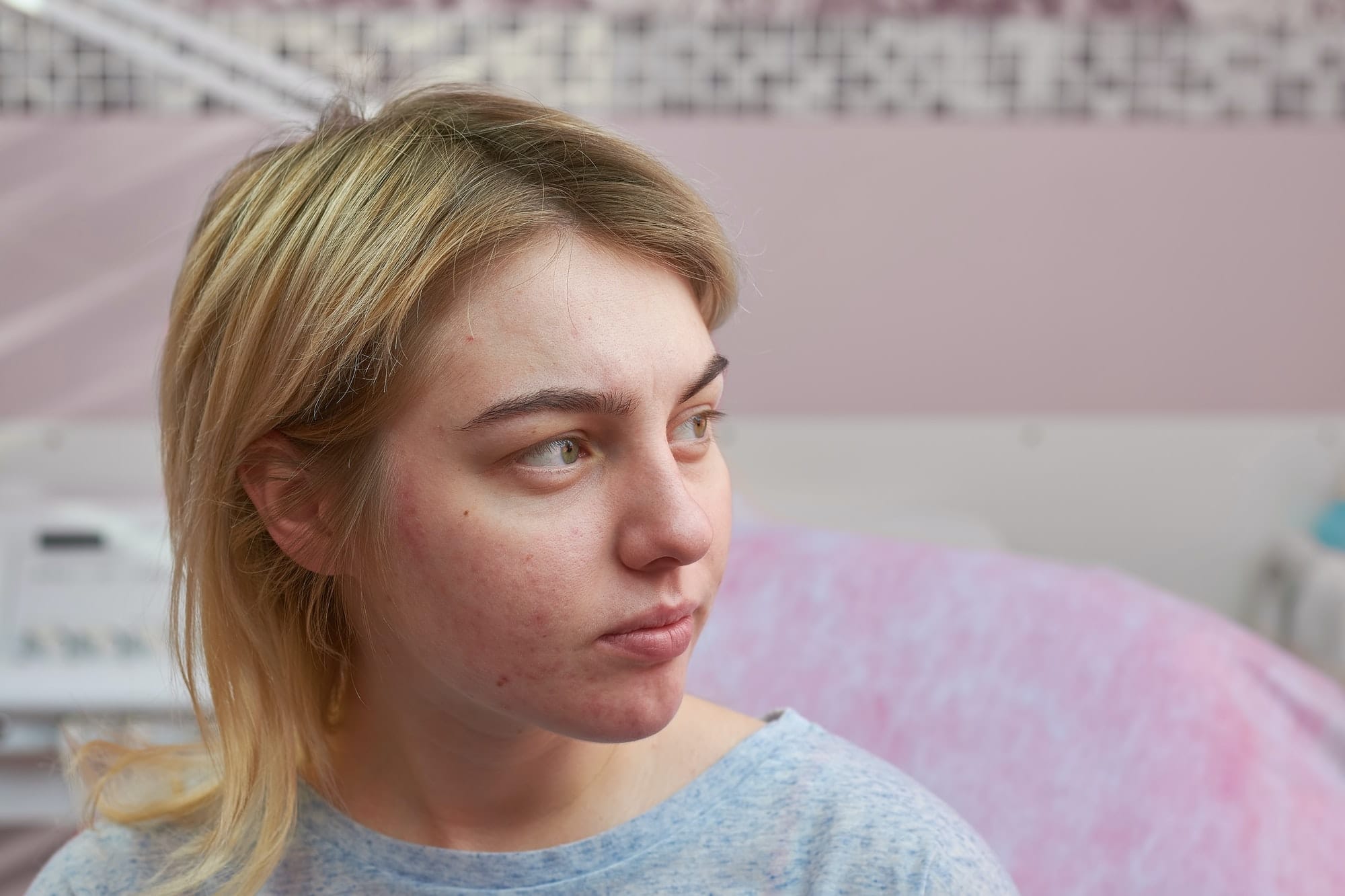 jeune femme avec de l'acné