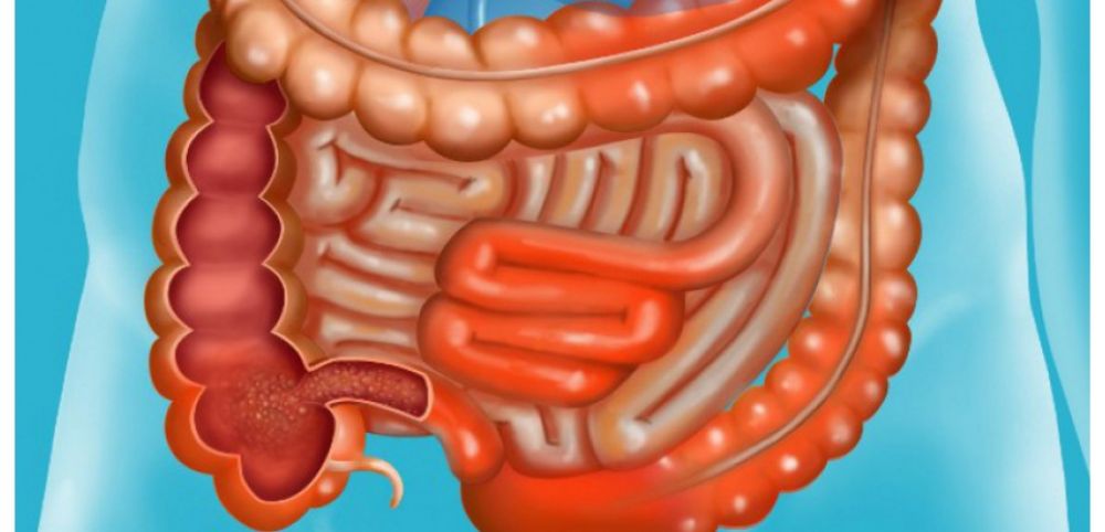 maladie de crohn, inflammation du tube digestif