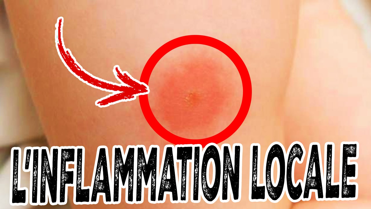 inflammation locale / aiguë