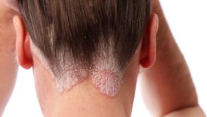 psoriasis et cheveux