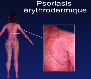 psoriasis érythrodermique