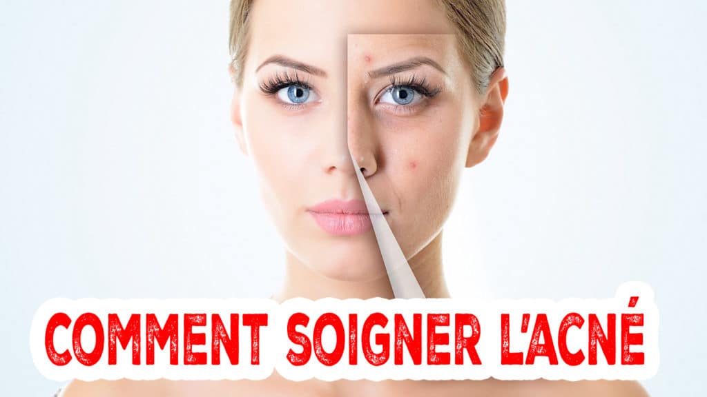 Comment soigner l'acné naturellement