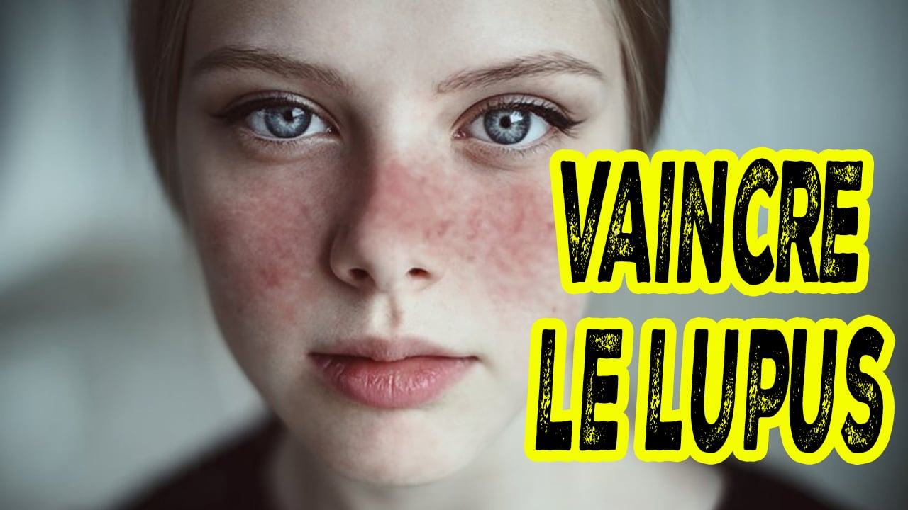 vaincre le lupus